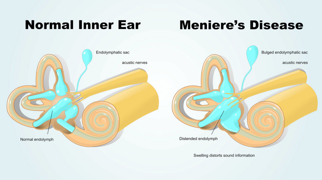 An illustration showing an inner ear structure, symbolizing Meniere's Disease and its impact on overall health.
