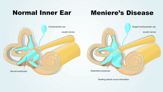 An illustration showing an inner ear structure, symbolizing Meniere's Disease and its impact on overall health.